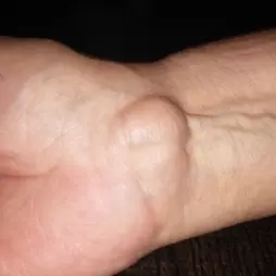 Ganglion – vznik a obvyklá léčba