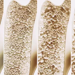 Osteoporóza