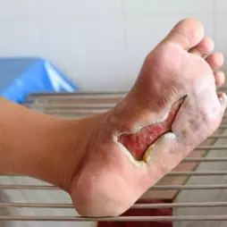 Rázová vlna jako možná terapie kožních vředů