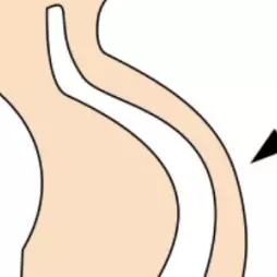 Horní/dolní zkřížený a vrstvový syndrom