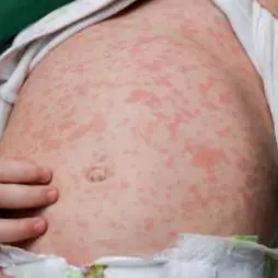 Kojení a alergie: průvodce alergeny v mateřském mléce a jak s nimi zacházet
