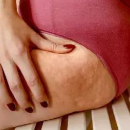 Celulitida: co to je, proč vzniká a jak ji lze řešit