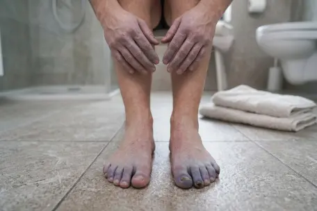 Modrofialové zbarvení prstů na nohou při poruše prokrvení dolních končetin.