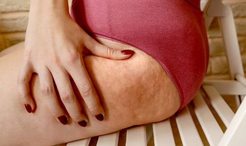 Celulitida: co to je, proč vzniká a jak ji lze řešit