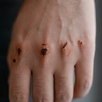 Jak rychle a kvalitně ošetřit rozseknutou kůži bez šití