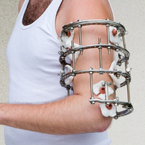 Tříštivá zlomenina kosti – fyzioterapie po zlomenině se zevním fixátorem